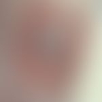 Necrobiosis lipoidica: Sharply defined, centrally atrophic plaque, distinct brown-red tinged edge...