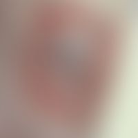 Necrobiosis lipoidica:&nbsp;scharf begrenzte, zentral deutlich atrophische Plaque, hervortretende...