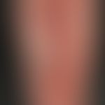 Necrobiosis lipoidica; overview of the right lower leg: Approx. 7 x 20 cm large, sharply defined,...