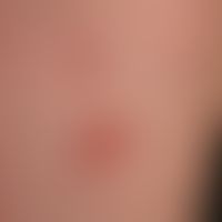 Necrobiosis lipoidica: Overview of the left thigh: Approx. 3 cm large, slightly elevated, erythem...