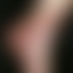 Necrobiosis lipoidica: chronic, sharply defined, flat, centrally atrophic, smooth plaque with cle...