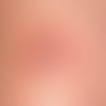 Necrobiosis lipoidica: Discrete finding with slightly hardened plaque and atrophic surface (parch...