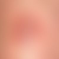 Necrobiosis lipoidica: Discrete finding with slightly hardened plaque and atrophic surface (parch...