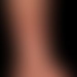 Necrobiosis lipoidica: different clinical sections. frontal, large, little indurated, slightly re...