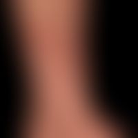 Necrobiosis lipoidica: different clinical sections. frontal, large, little indurated, slightly re...