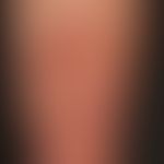 necrobiosis lipoidica: necrobiosis lipoidica that has existed for several years. extensive scarri...