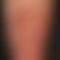 necrobiosis lipoidica: necrobiosis lipoidica that has existed for several years. extensive scarri...