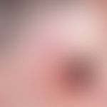 Neurofibrom. Große, weiche, leicht gerötete, wammenartige Gewebevergrößerung im Bereich der recht...