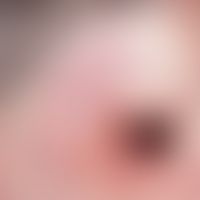 Neurofibrom. Große, weiche, leicht gerötete, wammenartige Gewebevergrößerung im Bereich der recht...