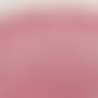 Neurofibrom. Gemischtes Neurofibrom mit diffusem Anteil im oberen und mittleren Teil der Dermis s...