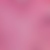 Neurofibrom. Diffuses Neurofibrom mit dichtem, zellreichem Stroma das die gesamte Dermis homogen ...