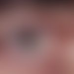 Neurofibrom. Bei dem 35-jährigen Patienten besteht im Bereich des rechten Unterlides ein erbsgroß...