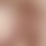Neurofibrom. 53 Jahre alte Patientin, die am Integument diese große, in der Querachse etwa 25 cm ...