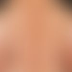 Type I Neurofibromatosis, peripheral type or classic cutaneous form Peripheral neurofibromatosis ...
