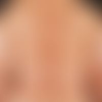 Type I Neurofibromatosis, peripheral type or classic cutaneous form Peripheral neurofibromatosis ...