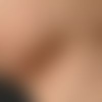 type I neurofibromatosis, peripheral type or classic cutaneous form. since puberty slowly increas...