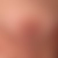 Type I neurofibromatosis, peripheral type or classic cutaneous form. massive tumorous transformat...
