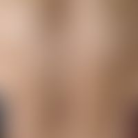 type i neurofibromatosis, peripheral type or classic cutaneous form. since puberty slowly increas...
