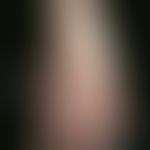 Type I Neurofibromatosis, peripheral type or classic cutaneous form. Permanent, multiple, skin-co...