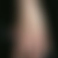 Typ&nbsp;I Neurofibromatose, peripherer Typ oder klassische kutane Form. Permanente, multiple, ha...
