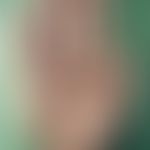 Central-peripheral neurofibromatosis (palmo-plantar neurofibromatosis or type III neurofibromatos...
