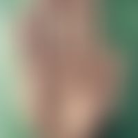 Central-peripheral neurofibromatosis (palmo-plantar neurofibromatosis or type III neurofibromatos...
