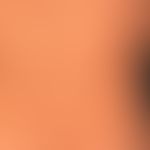 type I neurofibromatosis, peripheral type or classic cutaneous form. numerous smaller and larger ...