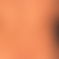 type I neurofibromatosis, peripheral type or classic cutaneous form. numerous smaller and larger ...