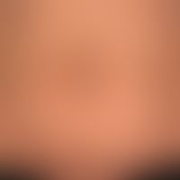 Neurofibromatosis segmental, type V Neurofibromatosis. Unilaterally distributed café au lait stai...