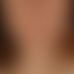 Type I Neurofibromatosis, peripheral type or classic cutaneous form, numerous smaller and larger ...