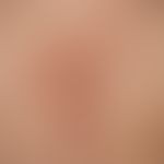 type i neurofibromatosis, peripheral type or classic cutaneous form. numerous smaller and larger ...
