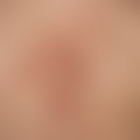type i neurofibromatosis, peripheral type or classic cutaneous form. numerous smaller and larger ...