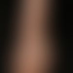 Type I Neurofibromatosis, peripheral type or classic cutaneous form, numerous soft cutaneous and ...
