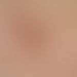 Notalgia paraesthetica. unspecific picture: Since 15 years persistent, palm-sized, recurrent in i...