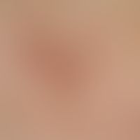 Notalgia paraesthetica. unspecific picture: Since 15 years persistent, palm-sized, recurrent in i...