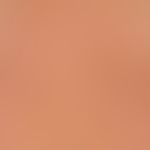 Notalgia paraesthetica, general view: Infrascapular macula on the right side, measuring about 5 x...