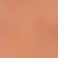 Notalgia paraesthetica, general view: Infrascapular macula on the right side, measuring about 5 x...