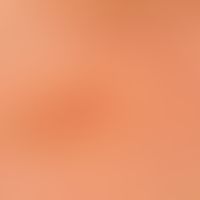 Notalgia paraesthetica. detail enlargement: Approx. 5 x 4 cm measuring, burning, itchy, brownish ...