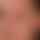 edema. general view: chronic, asymmetrical, limited to the left half of the face, which has been ...