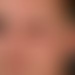 edema. general view: chronic, asymmetrical, limited to the left half of the face, which has been ...