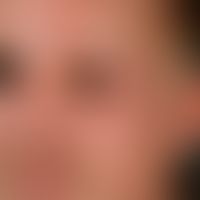edema. general view: chronic, asymmetrical, limited to the left half of the face, which has been ...