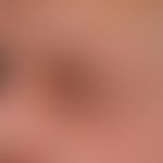 Edema. detail enlargement: asymmetrical, on the left side of the face limited, after surgical tre...