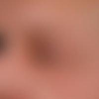 Edema. detail enlargement: asymmetrical, on the left side of the face limited, after surgical tre...