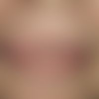 Edema: Collateral edema in an ulcer of the lip mucosa in the region of the right upper lip.