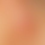 Ear fistula and cyst, congenital. external fistula opening impresses as an inflamed red nodule wi...