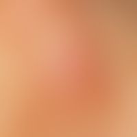 Ear fistula and cyst, congenital. external fistula opening impresses as an inflamed red nodule wi...