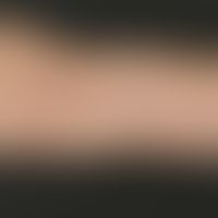 Oleom. Übersichtsaufnahme: Eher untypisches Bild einer schmerzhaften und livide verfärbten, geweb...