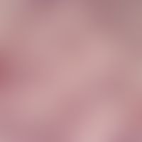 onchocerciasis. onchocerca volvulus. several t.s. through adult female worm. the thick cuticle (s...