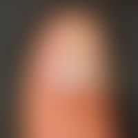 Onychodystrophia mediana canaliformis, probably trauma-induced (manipulative) central nail dystro...