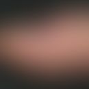 Onychodystrophia psoriatica. proximal strongly dented nail plate of the right thumb in a 26-year-...